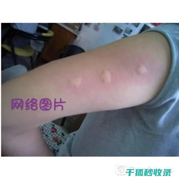 蚊虫叮咬后的止痒方法，让你轻松摆脱瘙痒 (蚊虫叮咬后的图片)