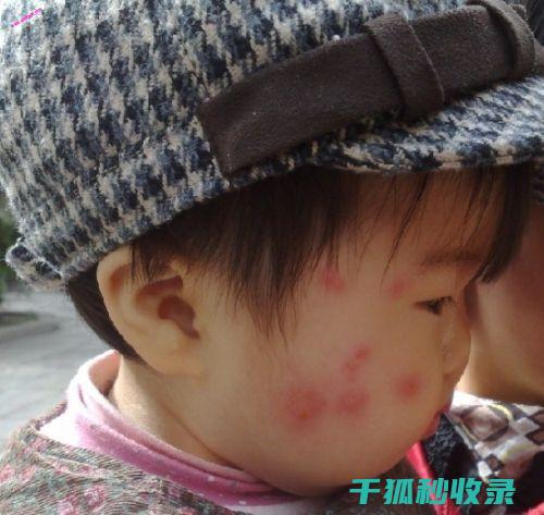 蚊虫叮咬后的止痒妙方，轻松缓解瘙痒 (蚊虫叮咬后的图片)