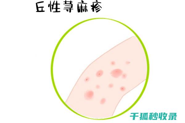 蚊虫叮咬后的止痒方法，这些你一定要知道 (蚊虫叮咬后的黑印子怎么去除)