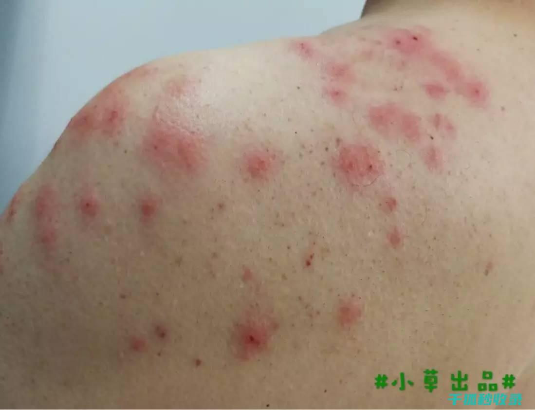 蚊虫叮咬后的止痒小窍门，让你轻松止痒 (蚊虫叮咬后的图片)